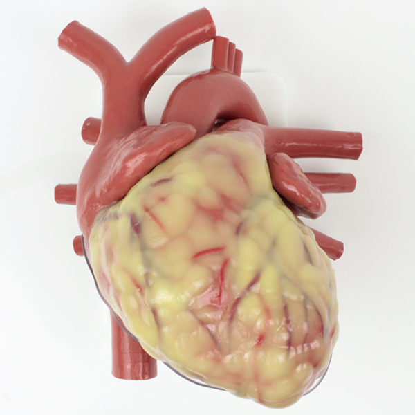 Largest Adult Heart Model, ie. dilated cardiomyopathy