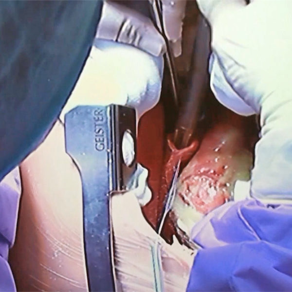ECMO Cannula placement in Cannulatable Beating Heart